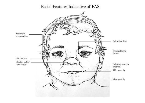 Facial Features FASD